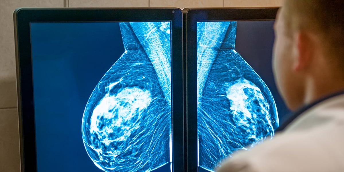Arzt schaut auf ein Brust-Mammogramm um Brustkrebs zu erkennen